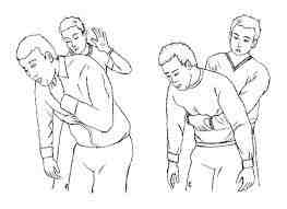 Heimlich maneuver: slap hard on the back of the chest 5 times in combination with pushing the abdomen upwards abruptly 5 times