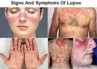 Lupus ban đỏ - bệnh nguy hiểm và khó chữa