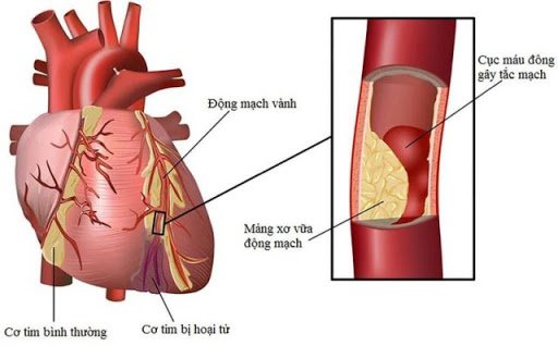 Xem xét thành phần hóa học mảng bám động mạch vành người