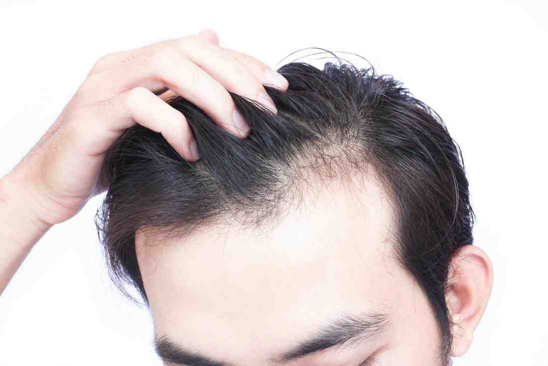Cơ chế rụng tóc Androgen