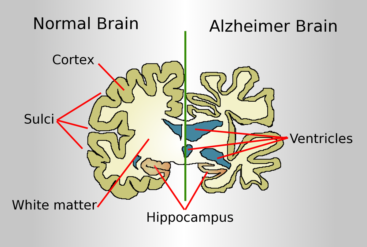 Alzheimer's disease (AD)