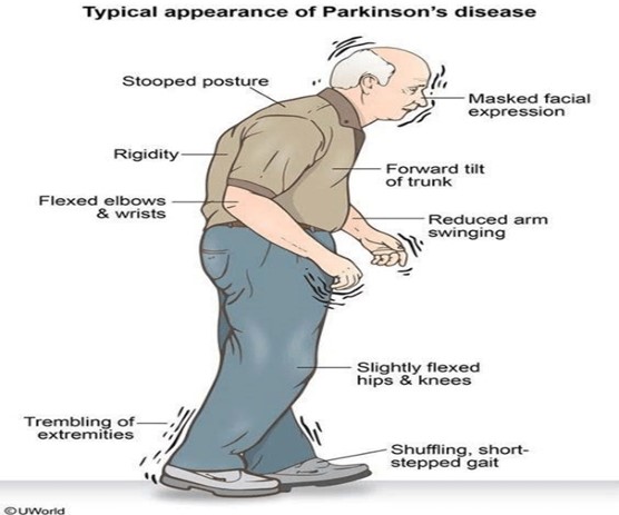 Parkinson - Chữa bằng đậu miêu và thuốc nam