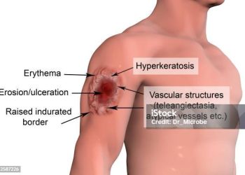 Bệnh do Leishmaniasis