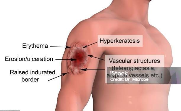 Bệnh do Leishmaniasis