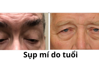 Droping eye với chứng sụp mí mắt trên do tích luỹ tuổi