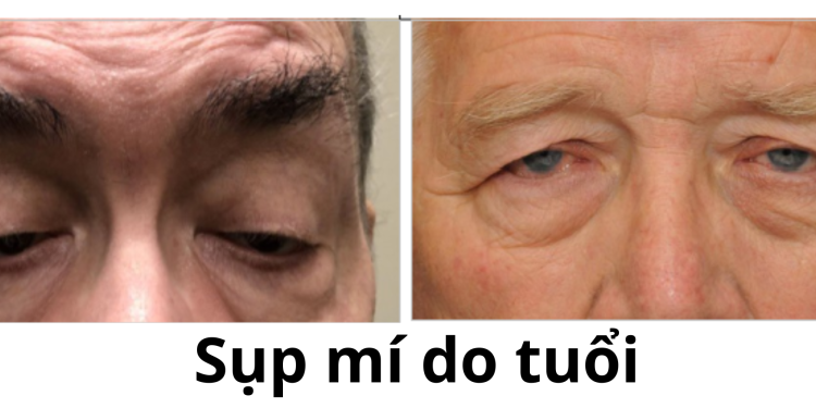 Droping eye với chứng sụp mí mắt trên do tích luỹ tuổi