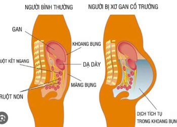 Chữa xơ gan cổ chướng trên người cao tuổi
