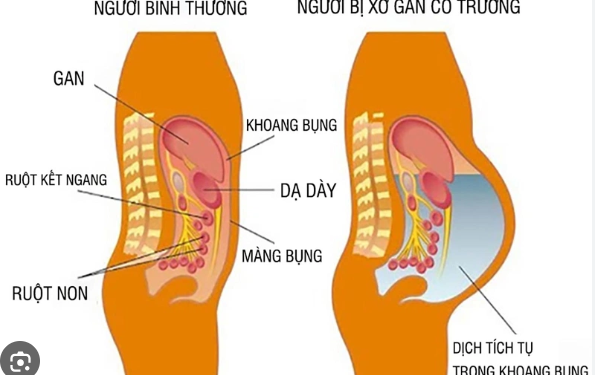 Chữa xơ gan cổ chướng trên người cao tuổi