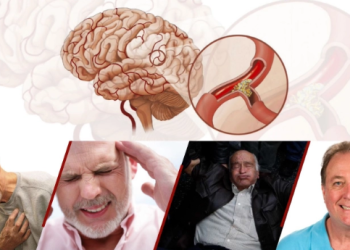 Đề phòng tai biến mạch máu não mùa xuân