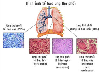 Ung thư phổi tế bào nhỏ