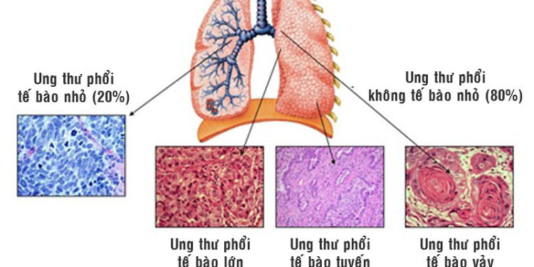 Ung thư phổi tế bào nhỏ