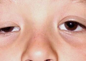 BỆNH NHƯỢC CƠ KHÓ CHỮA – KHẮC PHỤC KHÂU NÀO