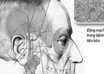 Bệnh viêm động mạch thái dương – dễ nhầm khó chữa dứt.