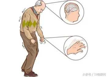 Các phương pháp điều trị bệnh Parkinson mới