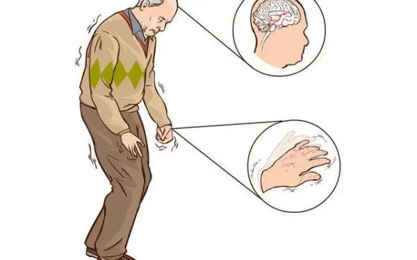 Các phương pháp điều trị bệnh Parkinson mới
