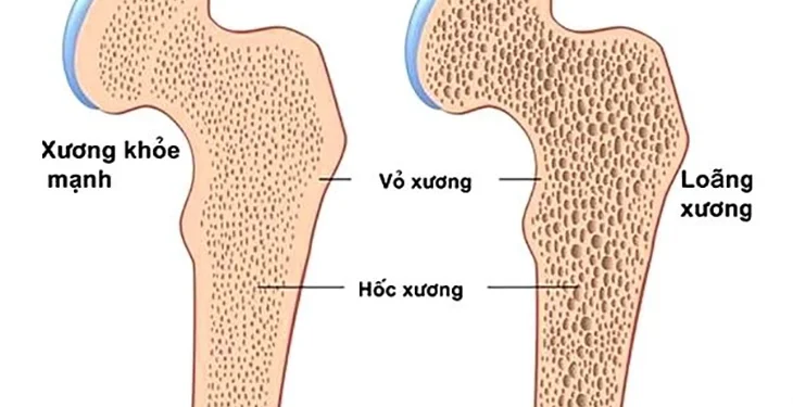 Chữa loãng xương không cần cung cấp bổ sung canxi