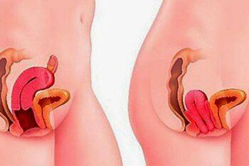 Báo cáo nghiên cứu đánh giá hiệu quả sản phẩm Zlove với sa sinh dục và giãn rộng âm đạo 