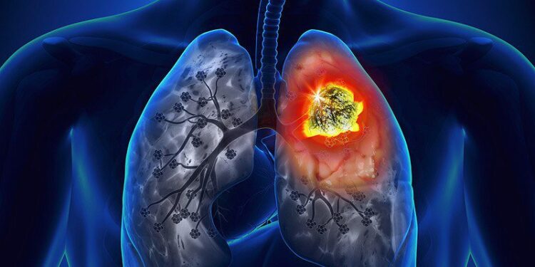 Đại cương về ung thư phổi