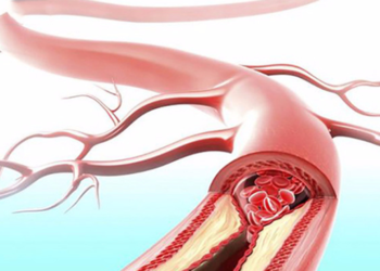 Hình thành mạch máu bất thường có thể nuôi tế bào ung thư