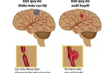 Hỏi đáp nhanh về đột quỵ não