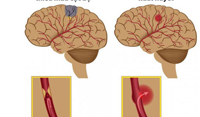 Hỏi đáp nhanh về đột quỵ não
