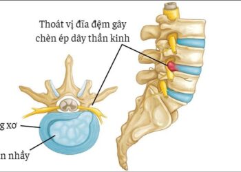 CÂU HỎI VỀ THOÁT VỊ ĐĨA ĐỆM CỦA BS BÙI THỊ VINH – NHÓM CLB TRAO ĐỔI Y THUẬT (ZALO)