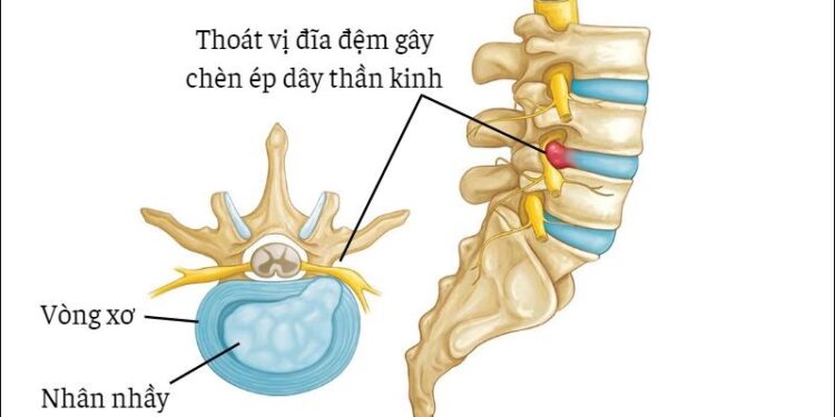 CÂU HỎI VỀ THOÁT VỊ ĐĨA ĐỆM CỦA BS BÙI THỊ VINH – NHÓM CLB TRAO ĐỔI Y THUẬT (ZALO)