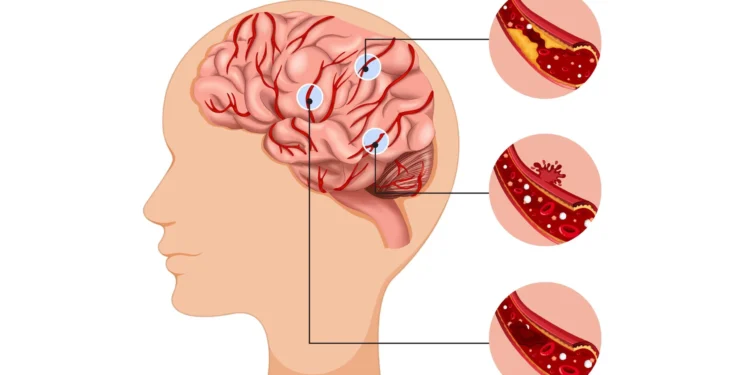 Đột quỵ não: viêm ổ nhồi máu cần được quan tâm ngay và đúng mức