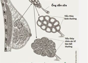 Ung thư vú, phần phụ, tử cung ăn gì và không ăn gì.