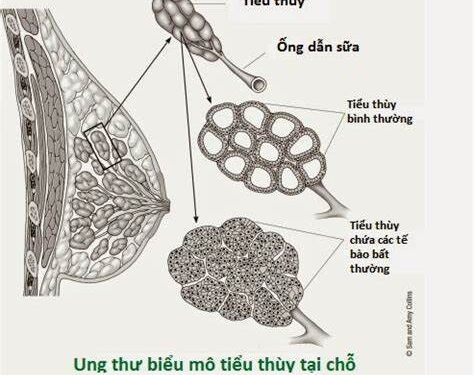 Ung thư vú, phần phụ, tử cung ăn gì và không ăn gì.