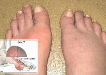 Phương pháp mới điều trị bệnh gút