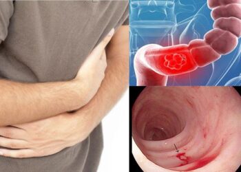 Chảy máu trực tràng sau xạ trị, nguyên nhân, cơ chế bệnh sinh. Điều trị