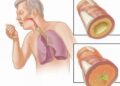 Chúng tôi nghiên cứu chữa hen và  COPD thế nào