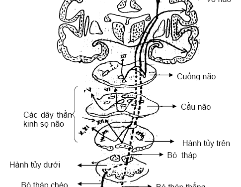 Trường hợp hội chứng ngoại tháp