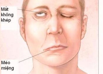 Liệt mặt ngoại biên và phương pháp điều trị đông tây y kết hợp