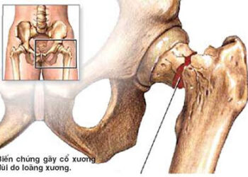 Chữa loãng xương không cần cung cấp bổ xung canxi