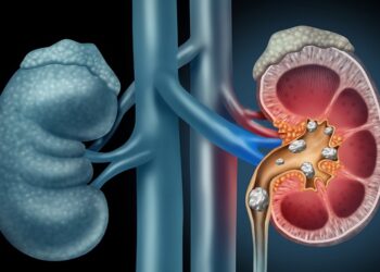 Sỏi thận và những định hướng mới cho nghiên cứu