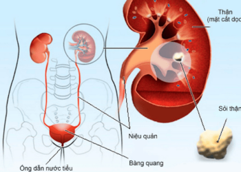 Chữa sỏi tiết niệu có sử dụng MgB6-áp dụng lần đầu