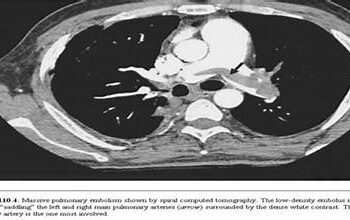 Viện Y học biển cứu được một bệnh nhân thuyên tắc bóng khí mạch não hy hữu.