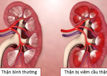 Ăn nhạt và uống thuốc nam khỏi bệnh viêm cầu thận mãn tính