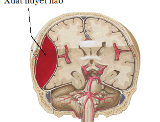 Xuất huyết não