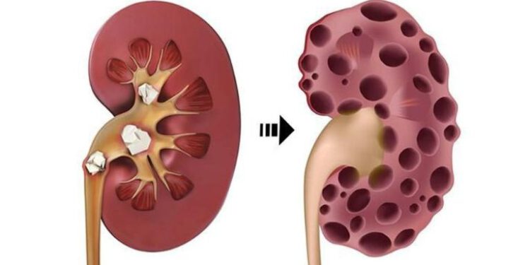 Tóm tắt nguyên nhân gây suy thận và các lưu ý