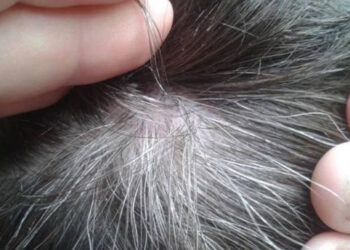 Bước đầu nghiên cứu bạc tóc và bạc tóc sớm