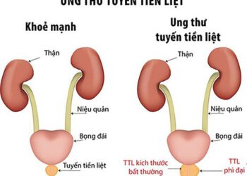 Điều trị ung thư tuyến tiền liệt bằng thuốc nam