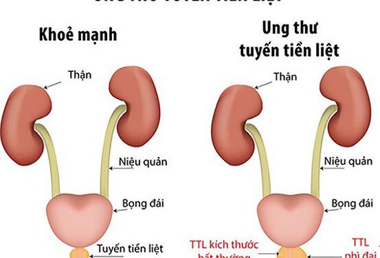 Điều trị ung thư tuyến tiền liệt bằng thuốc nam