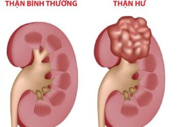 Sinh lý bệnh của Hội chứng thận hư