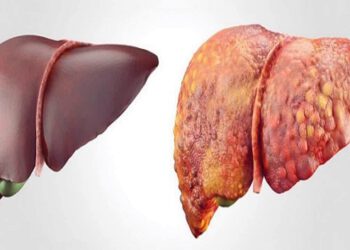 NHỮNG HIỂU BIẾT CƠ BẢN VỀ XƠ GAN VÀ CÁC ĐỊNH HƯỚNG ĐIỀU TRỊ