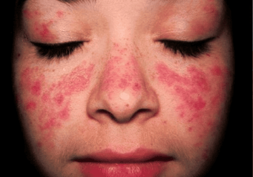 Lupus ban đỏ hệ thống và cơ chế lan truyền epitope: từ phản ứng chống virus đến tự miễn đa cơ quan