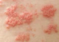 Virus Epstein–Barr và Lupus ban đỏ hệ thống: Cơ chế bệnh sinh, bằng chứng dịch tễ và hàm ý lâm sàng