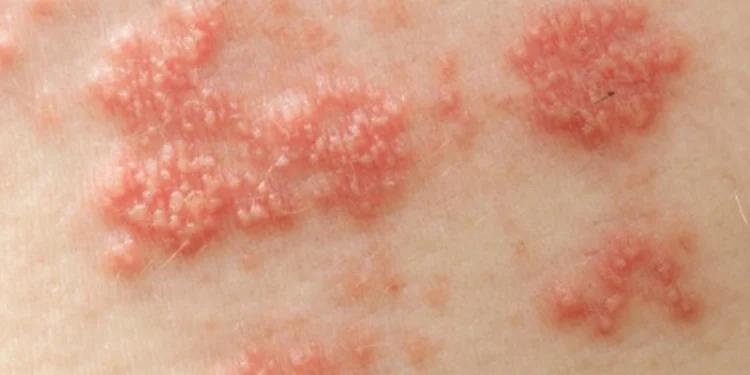 Virus Epstein–Barr và Lupus ban đỏ hệ thống: Cơ chế bệnh sinh, bằng chứng dịch tễ và hàm ý lâm sàng
